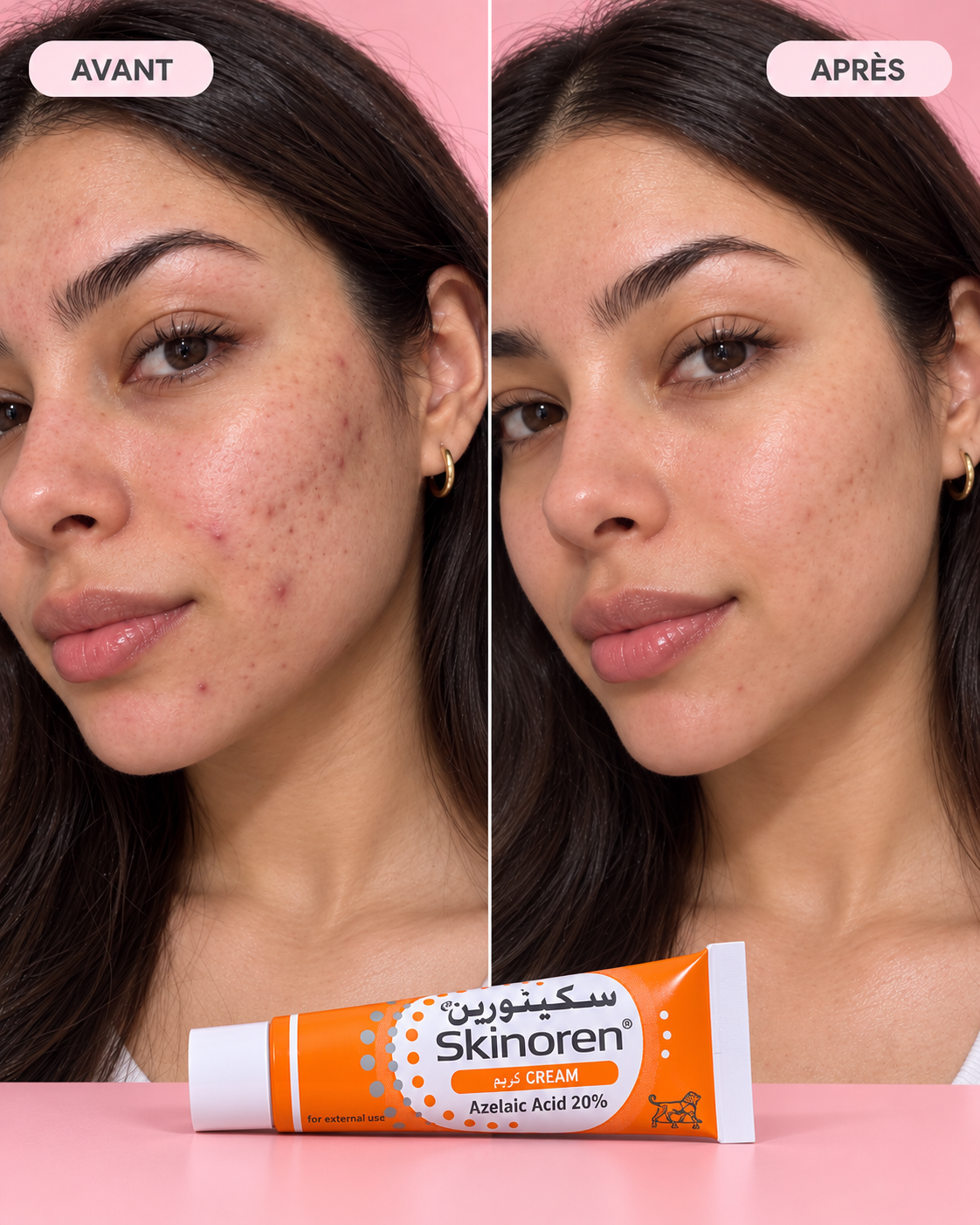 Skinoren Crème Acide Azélaïque 20%