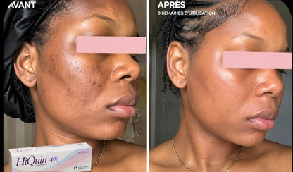 HiQuin 4% — Crème dépigmentante intensive tache