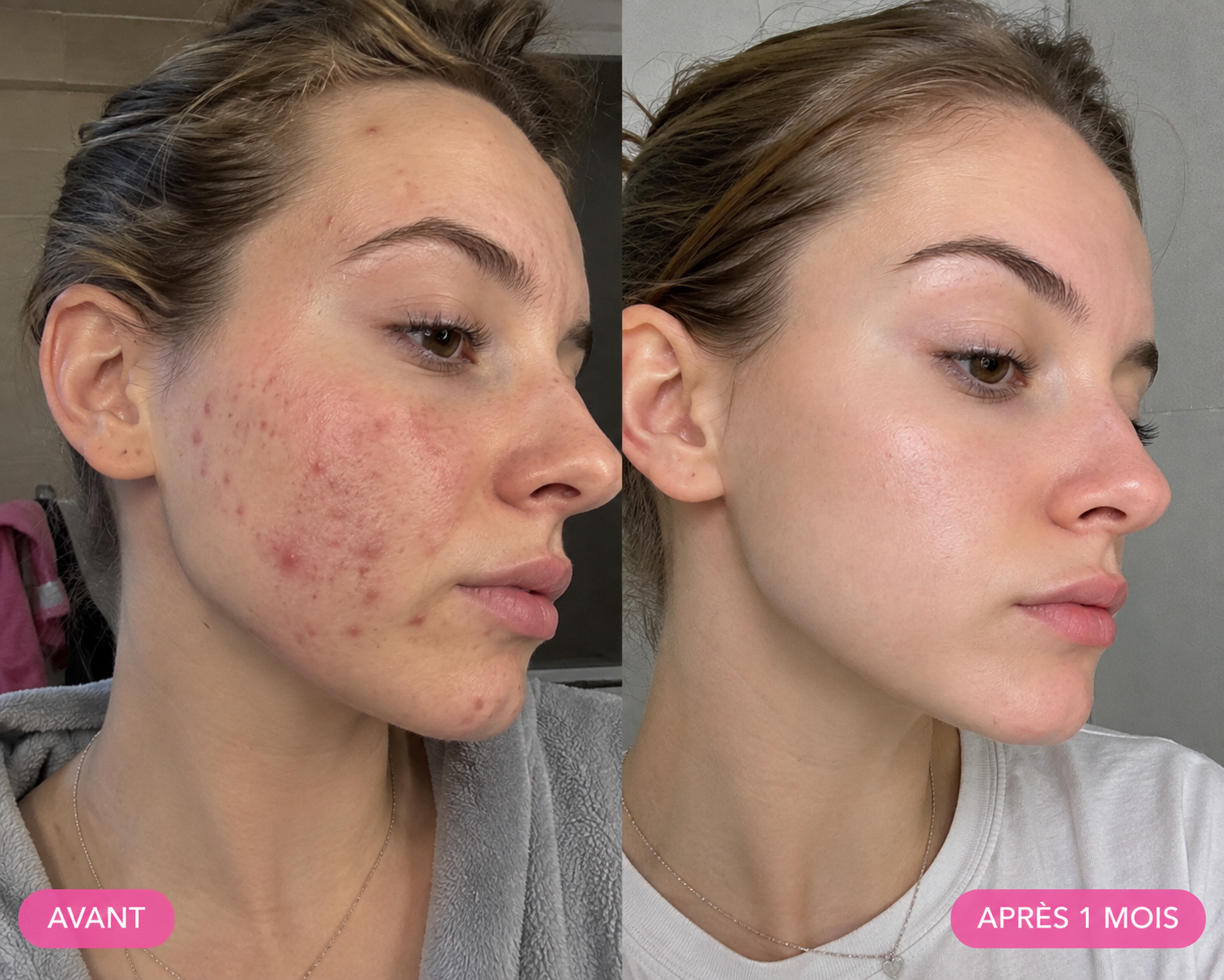 GlutaMaster Anti Acne Set original